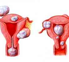 Tipuri de fibrom uterin