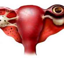 Simptome de sarcina ectopica in stadiile incipiente
