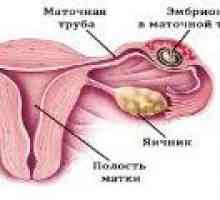 Sarcina extrauterină: simptome, semne, tratament
