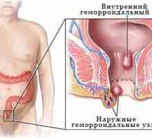 Hemoroizi interni - simptome