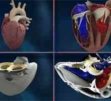 Franceză implantat prima inima artificiala