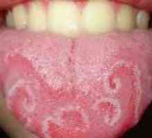 Inflamație a limbii (glosita) - cauze, diagnostic, tratament