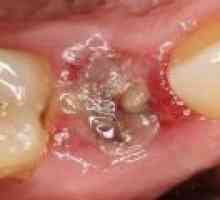 Inflamația după extracția dentară, tratamentul cu antibiotice