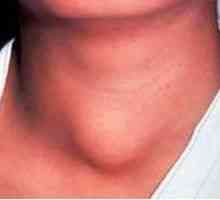 Inflamația a glandei tiroide (tiroidita): simptome și tratament