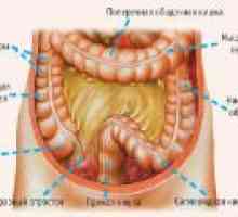 Inflamația colonului sigmoid: Simptome si tratament