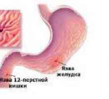 Inflamația stomacului și duodenului