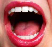Inflamația a glandei salivare
