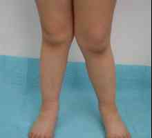Displazie congenitală a genunchiului
