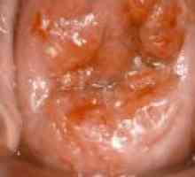 Alocarea după intoxicarea eroziune de col uterin