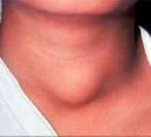 Boli tiroidiene la femei - Tratamentul