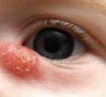 Boli ale sistemului lacrimal la copii
