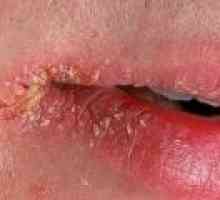 Perleches colțuri ale gurii: simptome, cauze, tratament