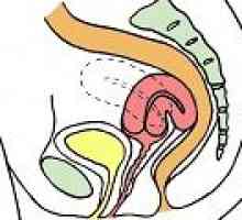 Îndoire a uterului - cauze, simptome, tratament