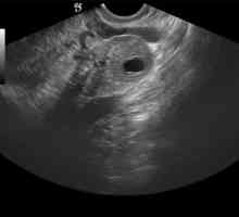 Corpus luteum in ovar în timpul sarcinii