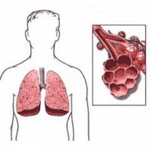 Abces pulmonar