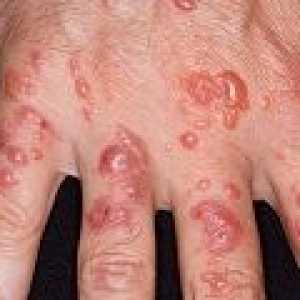Dermatita actinica: cauze, simptome, tratament