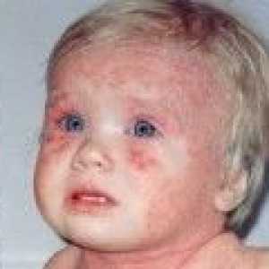 Dermatita atopica la copii, simptome și tratament