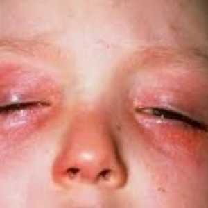 Alergia la ochi așa cum se manifestă? Cum de a trata?
