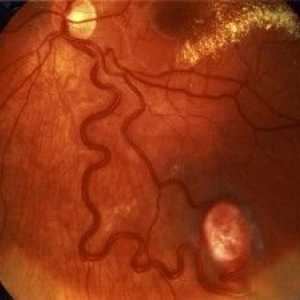 Ochii Angiomatoza retiniana