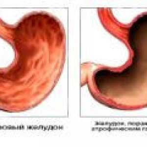 Antrale gastrita atrofică: Cauze, simptome, tratament