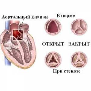 Stenoza aortica