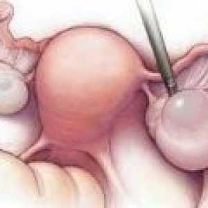 Apoplexie ovarian: cauze, simptome, tratament