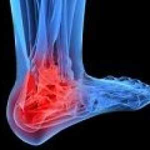Osteoartrita articulației gleznei: cauze, simptome, tratament