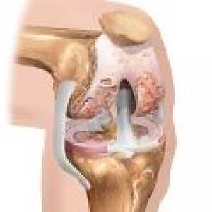 Osteoartrita de gradul genunchiului 3: Tratament