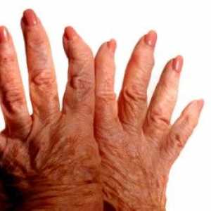 Osteoartrita a degetelor, simptome și tratament