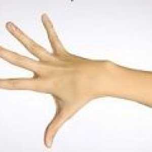 Osteoartrita a degetelor, articulațiile degetelor, cum de a trata?