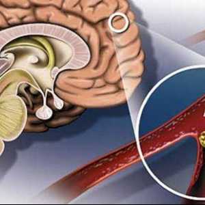 Simptomele aterosclerozei cerebrale și tratament