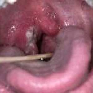 Atrofice faringita - cauze, simptome, tratament
