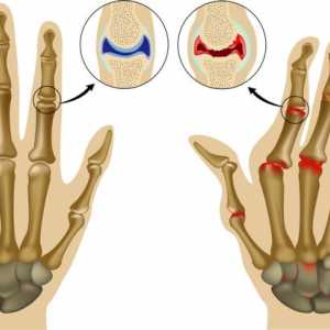 Tratarea biologică a artritei reumatoide: tratament și medicamente