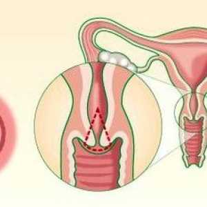 Biopsie de col uterin: ce este