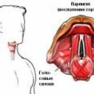 Durere în gât la înghițire, din cauza laringitei