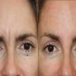 Botox tratament anti-rid - indicații de utilizare