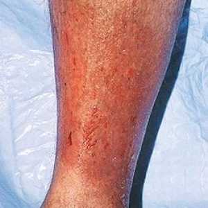 Cât de periculos dermatita varicos și dacă se poate vindeca de unul singur?
