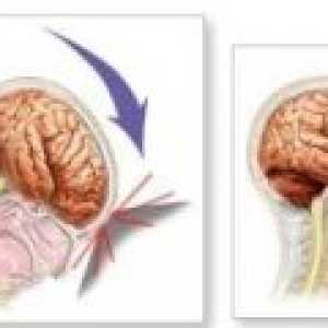 Traumatisme cranio-cerebrale - consecințele, reabilitare