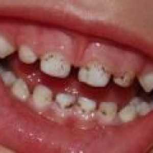 Ce se poate face în cazul în care placa ta copilul pe dinti?