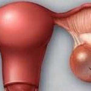 Chistadenomul de ovar - cauze, simptome, tratament