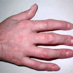 Deformarea degetului