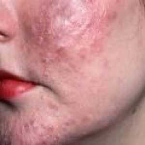 Acnee piele: cauze, simptome, tratament