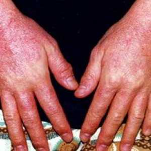 Diagnosticul și tratamentul dermatitei alergice