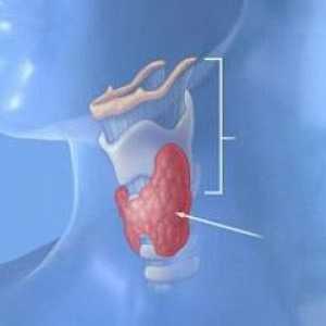 Modificări difuză a glandei tiroide