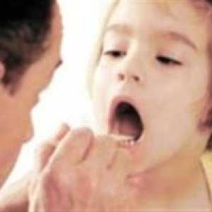 Difterie - boli infecțioase periculoase