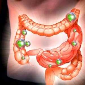 Intestinale disbioză: simptome și tratament la adulți