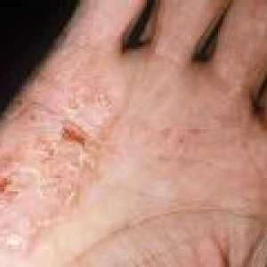 Disgidroticheskaya Eczeme - cauze, simptome, tratament
