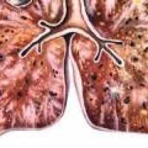 Diseminat tuberculoza: simptome, tratament