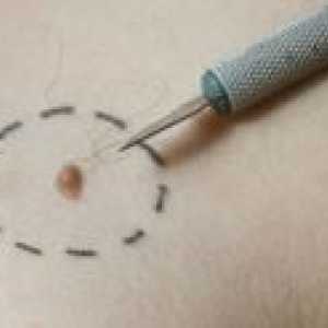 Avantajele și dezavantajele de tratamente de melanom