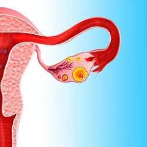 Fibrom ovarian